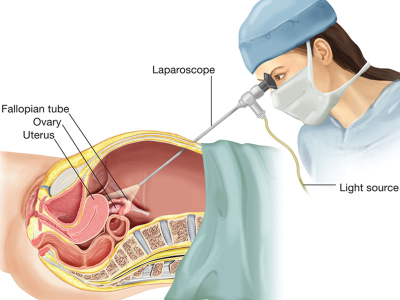 Laparoscopy treatment in pune